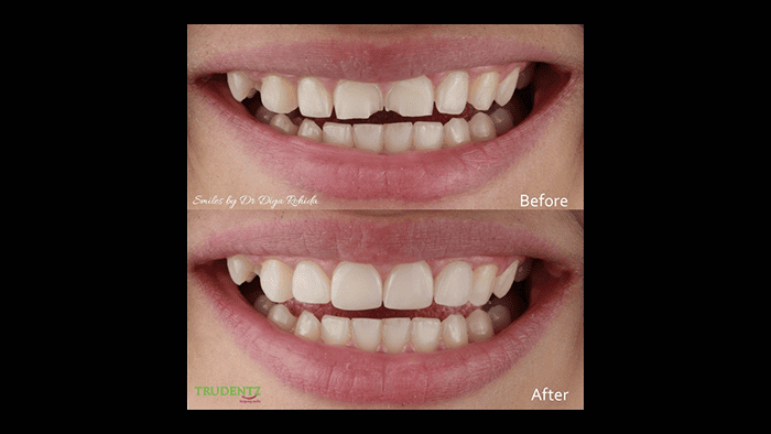 before-after7
