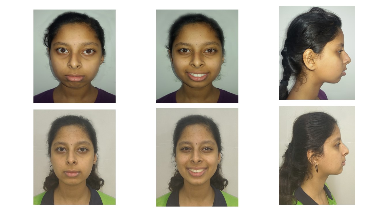  Case treated using Lingual Orthodontics