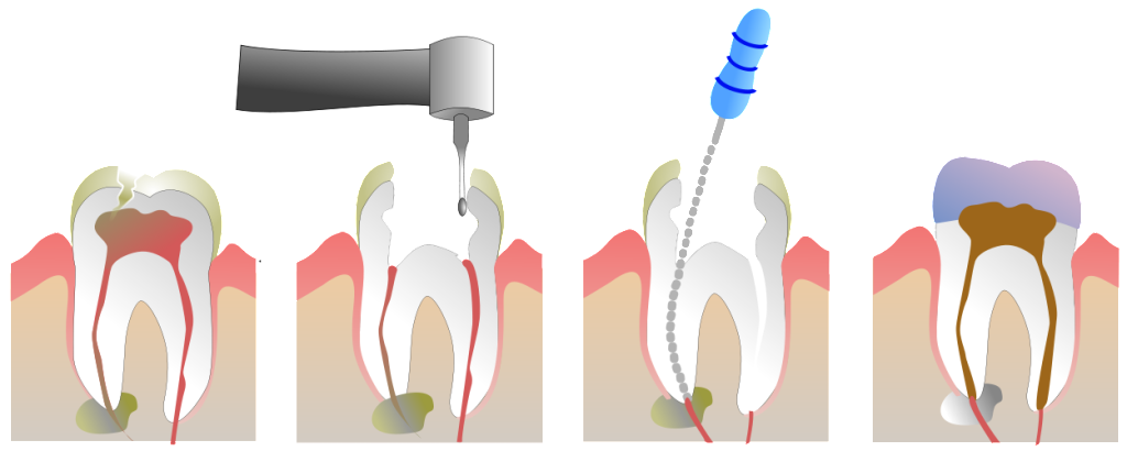 1250px-Root_Canal_Illustration_Molar