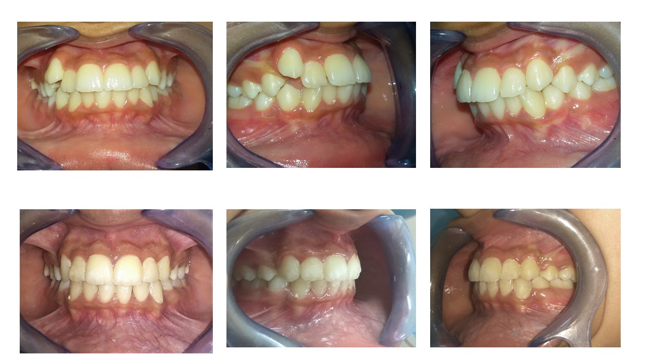 Orthodontic Treatment Results